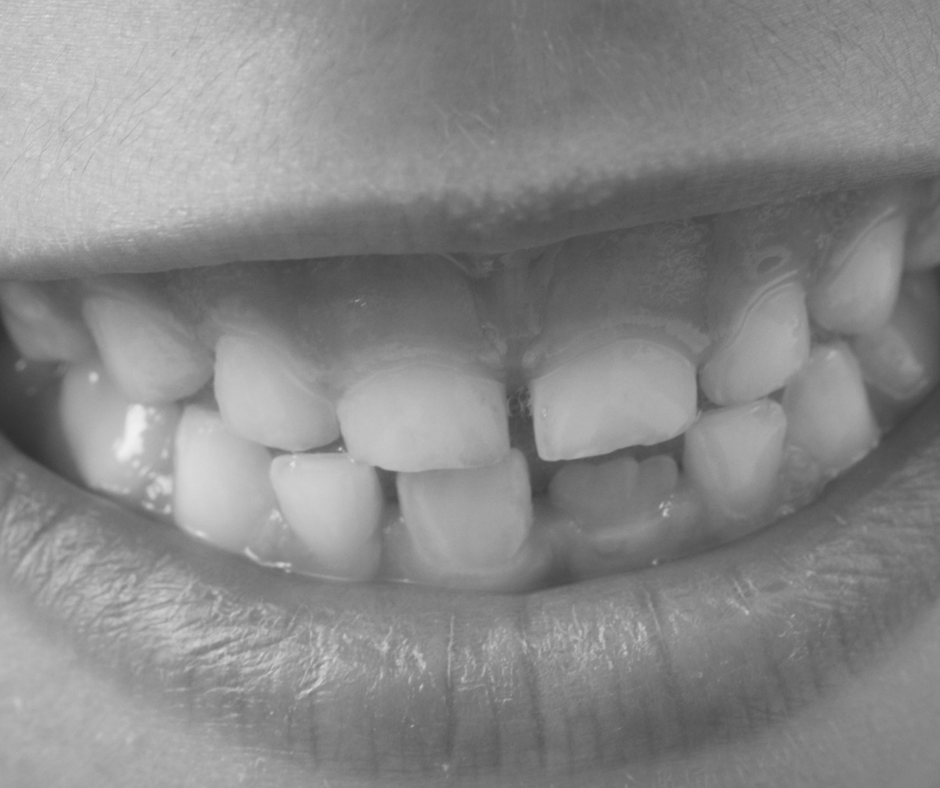 closeup of teeth